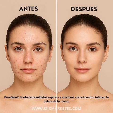 PureSkin® Extractor de Puntos Negros Eléctrico