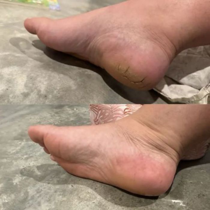 Smoothie 2.0 Removedor De Callos Electrico, Elimina los callos sin dolor