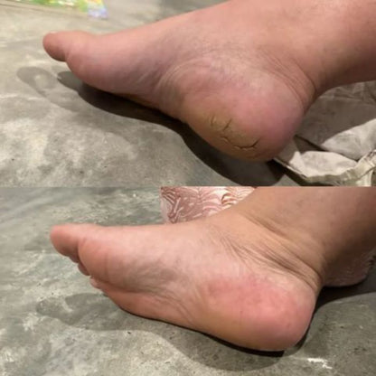 Smoothie 2.0 Removedor De Callos Electrico, Elimina los callos sin dolor